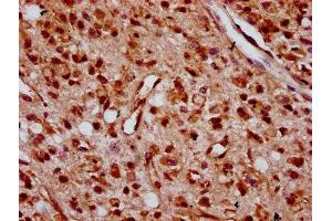 IHC image of ABIN7176263 diluted at 1:400 and staining in paraffin-embedded human glioma performed on a Leica BondTM system. (ZNF367 anticorps  (AA 83-151))
