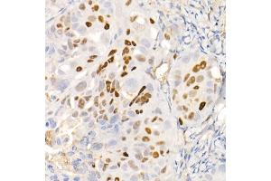 Immunohistochemistry of paraffin-embedded human colon carcinoma using [KO Validated] CDKN1A/p21CIP1 Rabbit mAb (ABIN7266599) at dilution of 1:100 (40x lens).