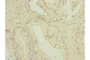 Immunohistochemistry of paraffin-embedded human prostate cancer using ABIN7159922 at dilution of 1:100