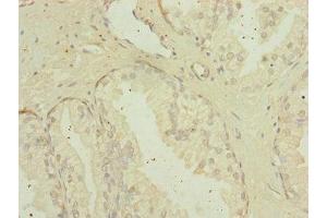 Immunohistochemistry of paraffin-embedded human prostate cancer using ABIN7159922 at dilution of 1:100 (MIPEP anticorps  (AA 504-713))