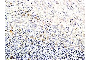 Formalin-fixed and paraffin embedded human colorectal cancer labeled with Anti-LI-cadherin Polyclonal Antibody, Unconjugated (ABIN732128) followed by conjugation to the secondary antibody and DAB staining