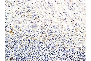 Formalin-fixed and paraffin embedded human colorectal cancer labeled with Anti-LI-cadherin Polyclonal Antibody, Unconjugated (ABIN732128) followed by conjugation to the secondary antibody and DAB staining (LI Cadherin anticorps  (AA 101-200))