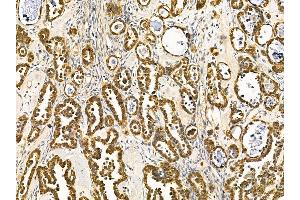 ABIN7095662 and ABIN7099724 at 1/100 staining human ovarian cancer by IHC-P.