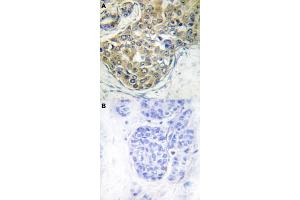 Immunohistochemical staining (Formalin-fixed paraffin-embedded sections) of human breast cancer tissue with TNK2 (phospho Y284) polyclonal antibody  without blocking peptide (A) or preincubated with blocking peptide (B) under 1:50-1:100 dilution.