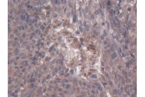 Detection of CSF2Rb in Human Ovarian cancer Tissue using Polyclonal Antibody to Colony Stimulating Factor 2 Receptor Beta (CSF2Rb)