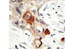 IHC analysis of FFPE human breast carcinoma tissue stained with the UBE2I antibody