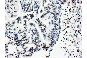 Immunohistochemical staining of paraffin-embedded Adenocarcinoma of Human breast tissue using anti-NT5DC1 mouse monoclonal antibody. (NT5DC1 anticorps)