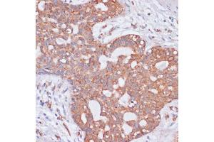 Immunohistochemistry of paraffin-embedded human breast cancer using KCNH2 antibody (ABIN3023435, ABIN3023436, ABIN3023437 and ABIN6219948) at dilution of 1:100 (40x lens).
