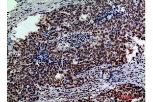 Immunohistochemistry (IHC) analysis of paraffin-embedded Human Breast Cancer, antibody was diluted at 1:200. (GLB1 anticorps)