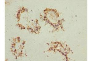 Immunohistochemistry of paraffin-embedded human breast cancer using ABIN7172902 at dilution of 1:100