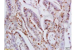 Formalin-fixed and paraffin embedded human colon carcinoma labeled with Rabbit Anti KLF4 Polyclonal Antibody, Unconjugated (ABIN737121) at 1:200 followed by conjugation to the secondary antibody and DAB staining (KLF2/4 anticorps  (AA 415-513))