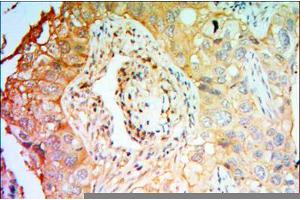 Immunohistochemical analysis of paraffin-embedded lung cancer tissues using PTK7 mouse mAb with DAB staining. (PTK7 anticorps)