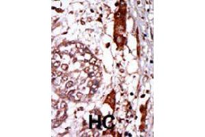 Formalin-fixed and paraffin-embedded human hepatocellular carcinoma tissue reacted with GNB2L1 polyclonal antibody  , which was peroxidase-conjugated to the secondary antibody, followed by AEC staining. (CDR2 anticorps  (N-Term))