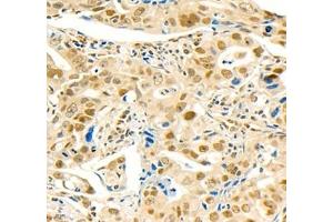 Immunohistochemistry of paraffin embedded human gastric cancer using MST1 (ABIN7075561) at dilution of 1: 1000 (400x lens)