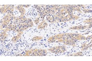 Detection of MAPK14 in Human Lung cancer Tissue using Polyclonal Antibody to Mitogen Activated Protein Kinase 14 (MAPK14) (MAPK14 anticorps  (AA 19-279))