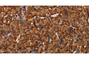 Immunohistochemistry of paraffin-embedded Human prostate cancer tissue using COL18A1 Polyclonal Antibody at dilution 1:40 (COL18A1 anticorps)