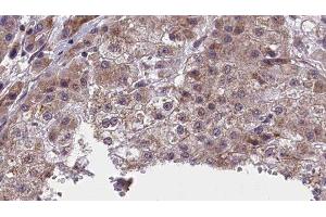ABIN6277415 at 1/100 staining Human liver cancer tissue by IHC-P.