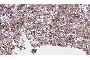 ABIN6277415 at 1/100 staining Human liver cancer tissue by IHC-P. (NFASC anticorps  (C-Term))