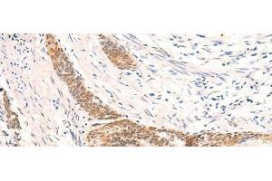 Immunohistochemistry of paraffin-embedded Human esophagus cancer tissue using HSPA4L Polyclonal Antibody at dilution of 1:30(x200) (HSPA4L anticorps)