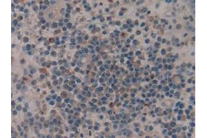 Detection of tPA in Human Skin cancer Tissue using Polyclonal Antibody to Tissue Plasminogen Activator (tPA)