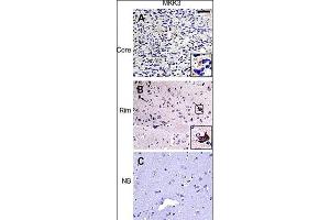 IHC of matched glioma core (top row) and rim (middle row) samples as well as normal brain control (bottom row) from a glioma invasion specific tissue microarray.
