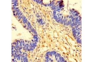 Immunohistochemistry of paraffin-embedded human ovarian cancer using ABIN7174393 at dilution of 1:100