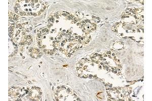 ZFP91 Mouse Monoclonal Antibody at 1/100 staining human ovarian cancer by IHC-P. (ZFP91 anticorps)