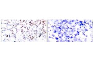 Immunohistochemical analysis of paraffin-embedded human breast carcinoma tissue using Myc (phospho- Thr358) antibody (E011035). (c-MYC anticorps  (pThr358))
