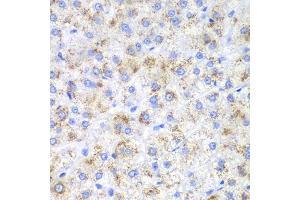 Immunohistochemistry of paraffin-embedded human liver cancer using HAO1 antibody (ABIN5973868) at dilution of 1/200 (40x lens). (HAO1 anticorps)