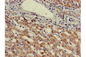 Immunohistochemistry of paraffin-embedded human liver cancer using ABIN7174571 at dilution of 1:100 (ube3a anticorps  (AA 83-234))