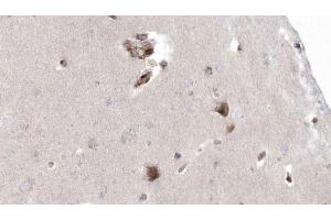ABIN6272926 at 1/100 staining Human brain cancer tissue by IHC-P. (OXCT1 anticorps  (Internal Region))