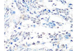 Immunohistochemistry of paraffin-embedded human lung cancer using MTA2 Antibody (ABIN5998268) at dilution of 1/100 (40x lens). (MTA2 anticorps)