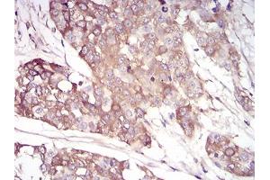 Immunohistochemical analysis of paraffin-embedded bladder cancer tissues using SERPINA3 mouse mAb with DAB staining.