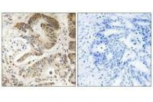 Immunohistochemistry analysis of paraffin-embedded human colon carcinoma tissue using PIK3R5 antibody. (PIK3R5 anticorps)