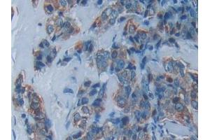 Detection of PKR in Human Breast cancer Tissue using Polyclonal Antibody to Protein Kinase R (PKR)