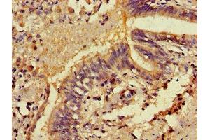 Immunohistochemistry of paraffin-embedded human lung cancer using ABIN7146326 at dilution of 1:100 (EFHA1 anticorps  (AA 26-247))
