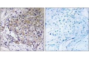 Immunohistochemistry analysis of paraffin-embedded human breast carcinoma tissue, using WASF3 Antibody. (WASF3 anticorps  (AA 151-200))