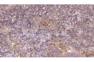 ABIN6273054 at 1/100 staining Human lymph cancer tissue by IHC-P. (MAT1A anticorps  (N-Term))
