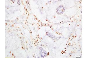 Formalin-fixed and paraffin embedded human colon carcinoma labeled with Rabbit Anti-YAP1 Polyclonal Antibody, Unconjugated 1:200 followed by conjugation to the secondary antibody and DAB staining