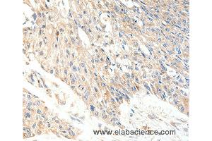 Immunohistochemistry of Human lung cancer using SLC27A1 Polyclonal Antibody at dilution of 1:40 (SLC27A1 anticorps)