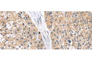 Immunohistochemistry of paraffin-embedded Human esophagus cancer tissue using RGS2 Polyclonal Antibody at dilution of 1:95(x200)
