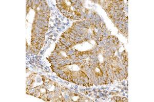 Immunohistochemistry of paraffin-embedded human colon carcinoma using GM130 antibody (ABIN6129789, ABIN6141264, ABIN6141265 and ABIN6220979) at dilution of 1:25 (40x lens). (Golgin A2 (GOLGA2) (AA 20-300) anticorps)