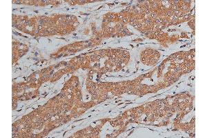ABIN6268699 at 1/200 staining human liver cancer tissue sections by IHC-P.