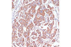 Immunohistochemistry of paraffin-embedded human liver cancer using LRP1 antibody (ABIN3021968, ABIN3021969, ABIN3021970 and ABIN6218530) at dilution of 1:100 (40x lens). (LRP1 anticorps  (AA 20-270))