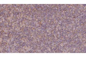 ABIN6273131 at 1/100 staining Human lymph cancer tissue by IHC-P.