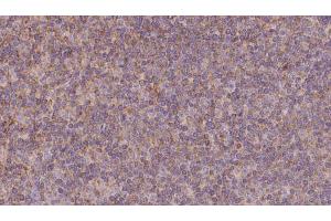 ABIN6273131 at 1/100 staining Human lymph cancer tissue by IHC-P. (KIFC3 anticorps  (C-Term))