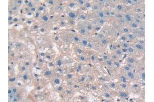 Detection of CD276 in Human Liver cancer Tissue using Polyclonal Antibody to Cluster Of Differentiation 276 (CD276)