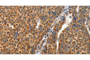 Immunohistochemistry of paraffin-embedded Human liver cancer tissue using ANGPTL1 Polyclonal Antibody at dilution 1:40 (ANGPTL1 anticorps)