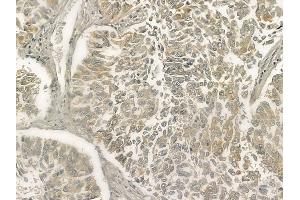 ABIN6263303 and ABIN6273267 at 1/100 staining human lung squamous cell carcinoma by IHC-P. (MMP28 anticorps  (Internal Region))
