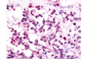 Anti-EAR2 / NR2F6 antibody IHC of human Breast, Carcinoma.